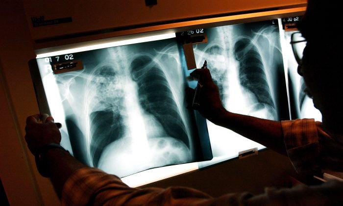 San Diego County Reports 17 Percent Increase in Tuberculosis Cases