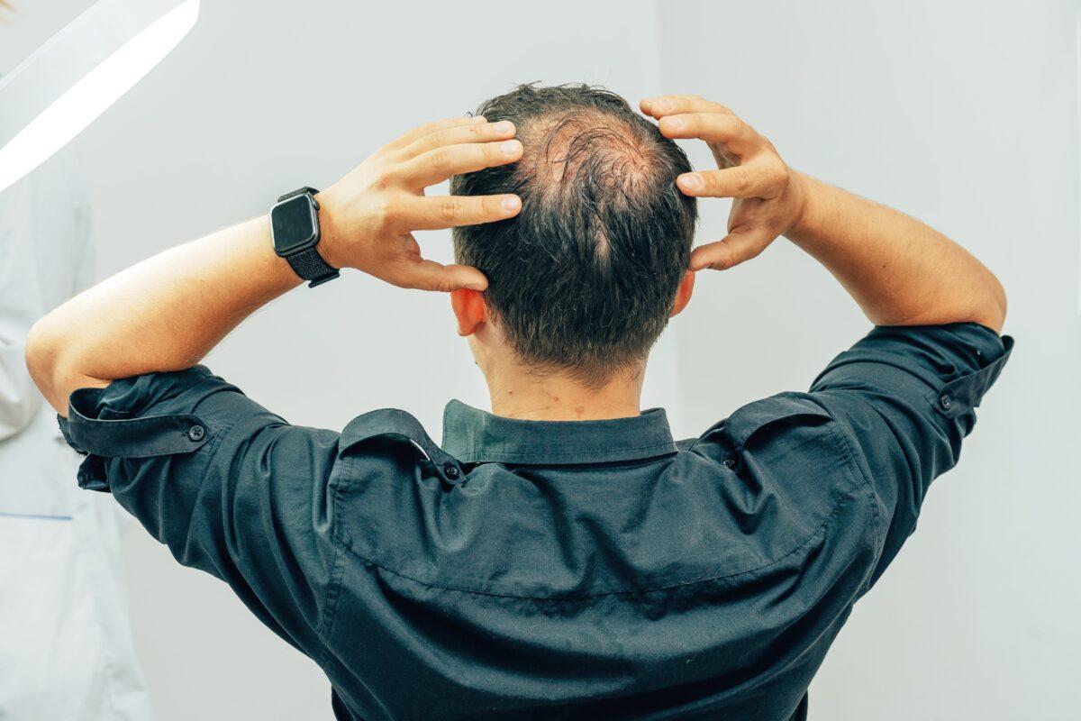 A man with male pattern baldness in a stock photo. (Yashkin Ilya/Shutterstock)