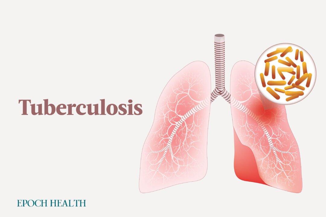 Tuberculosis: Symptoms, Causes, Treatments, and Natural Approaches
