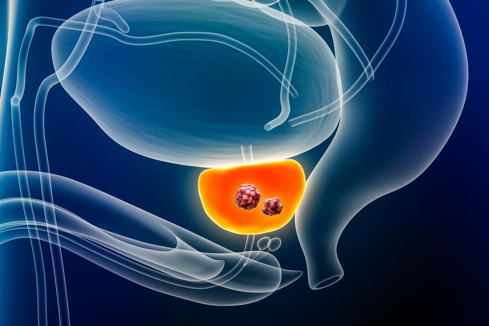 Who Should Undergo Routine Prostate Cancer Screenings?