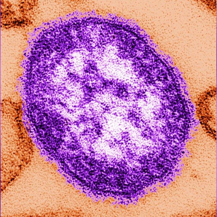US Has Recorded 58 Measles Cases So Far in 2024, Same as Total for All of 2023
