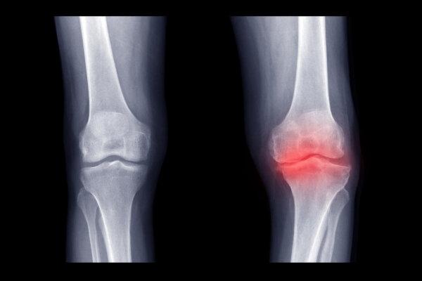 Pulsed Electromagnetic Field Therapy May Relieve Osteoarthritis: Study