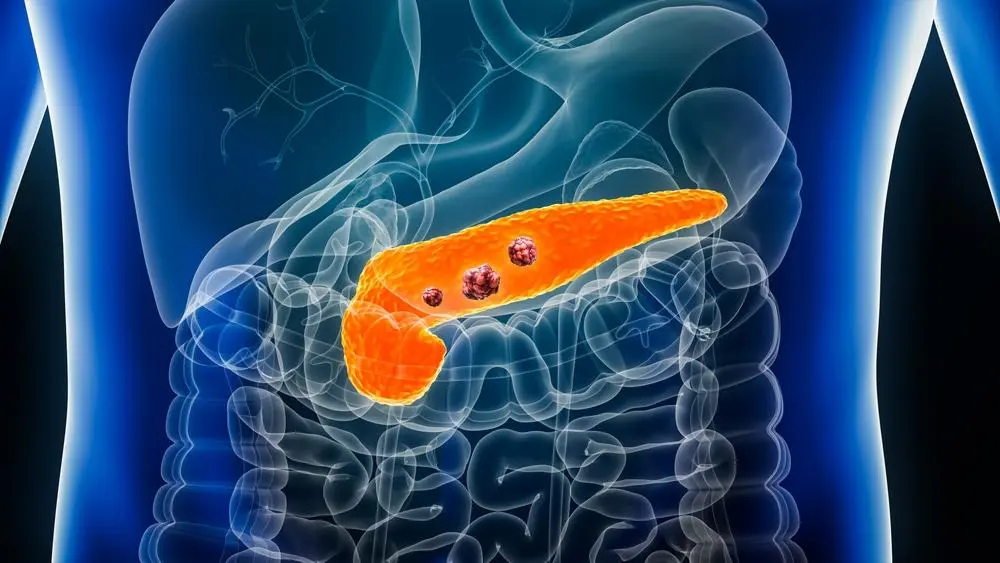 Potential Early Signs of Pancreatic Cancer: Insights From Clinical Cases
