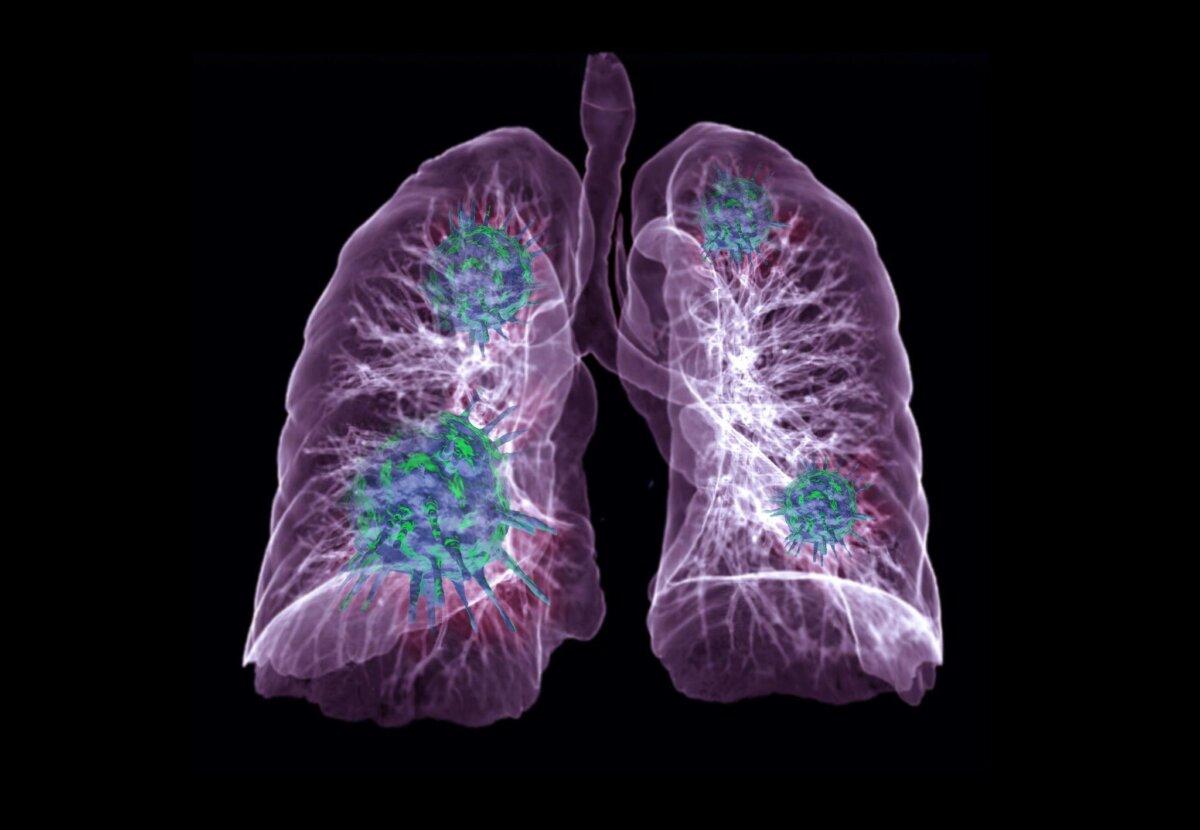 The incidence of pulmonary nodules has risen significantly following COVID-19 infection, making it crucial to rule out malignancy. (Radiological imaging/Shutterstock)