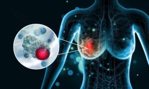 Facing Breast Cancer: Insights From Experts and a Doctor’s Inspiring Survival Journey