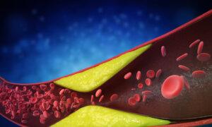 Protecting Your Heart: How High Cholesterol and Emotional Health Impact Atherosclerosis