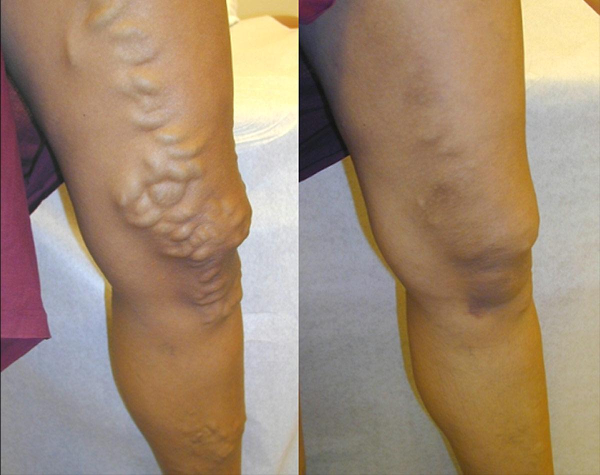 Varicose Veins Dangerous Without Treatment