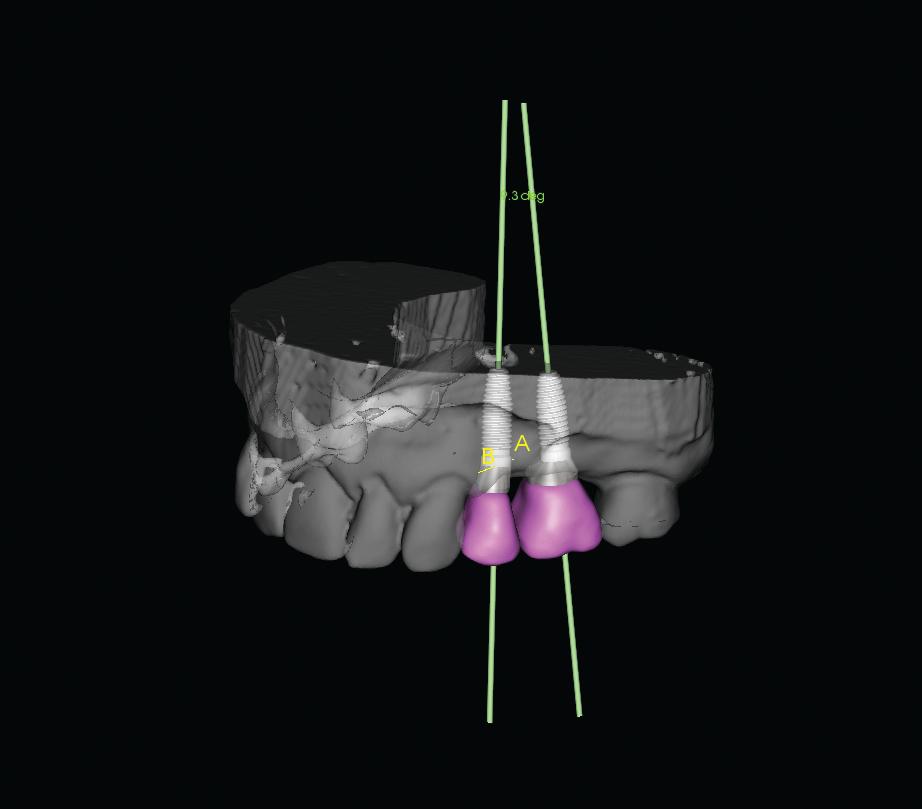 How Dental Implants Save Bone