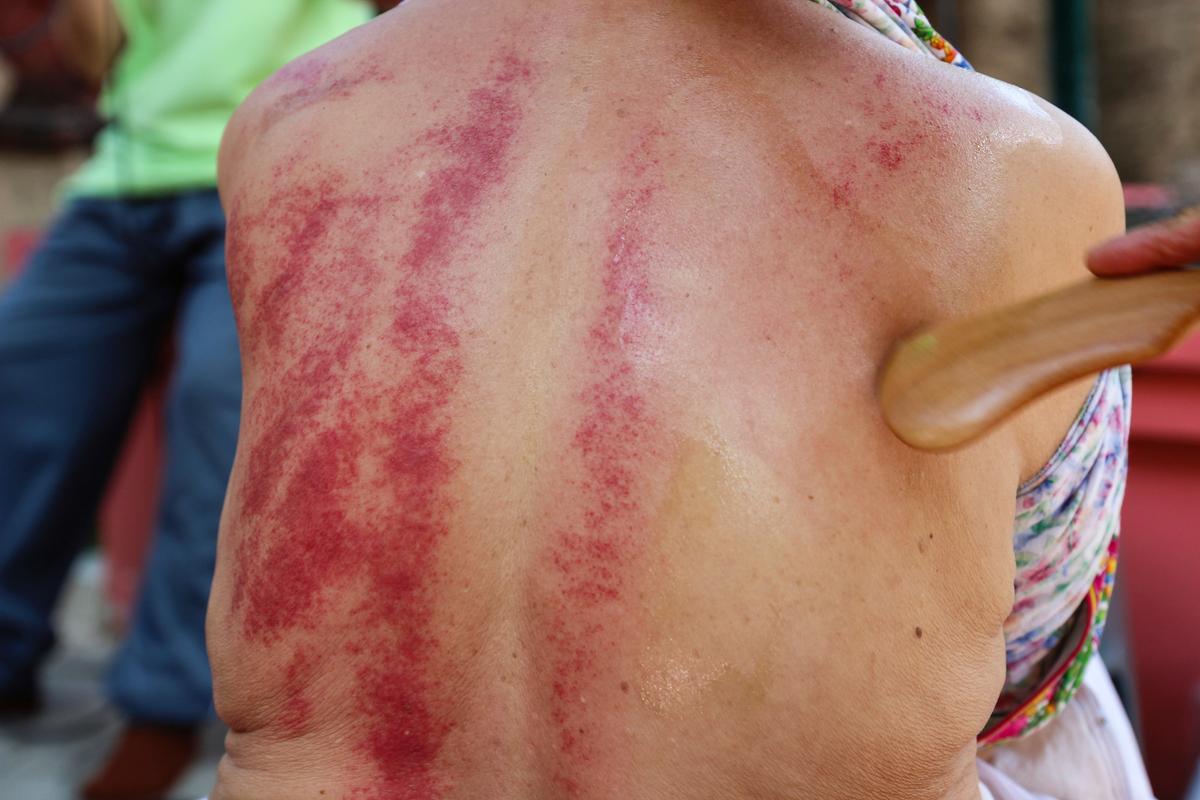 Ancient Technique Scrapes Away Pain