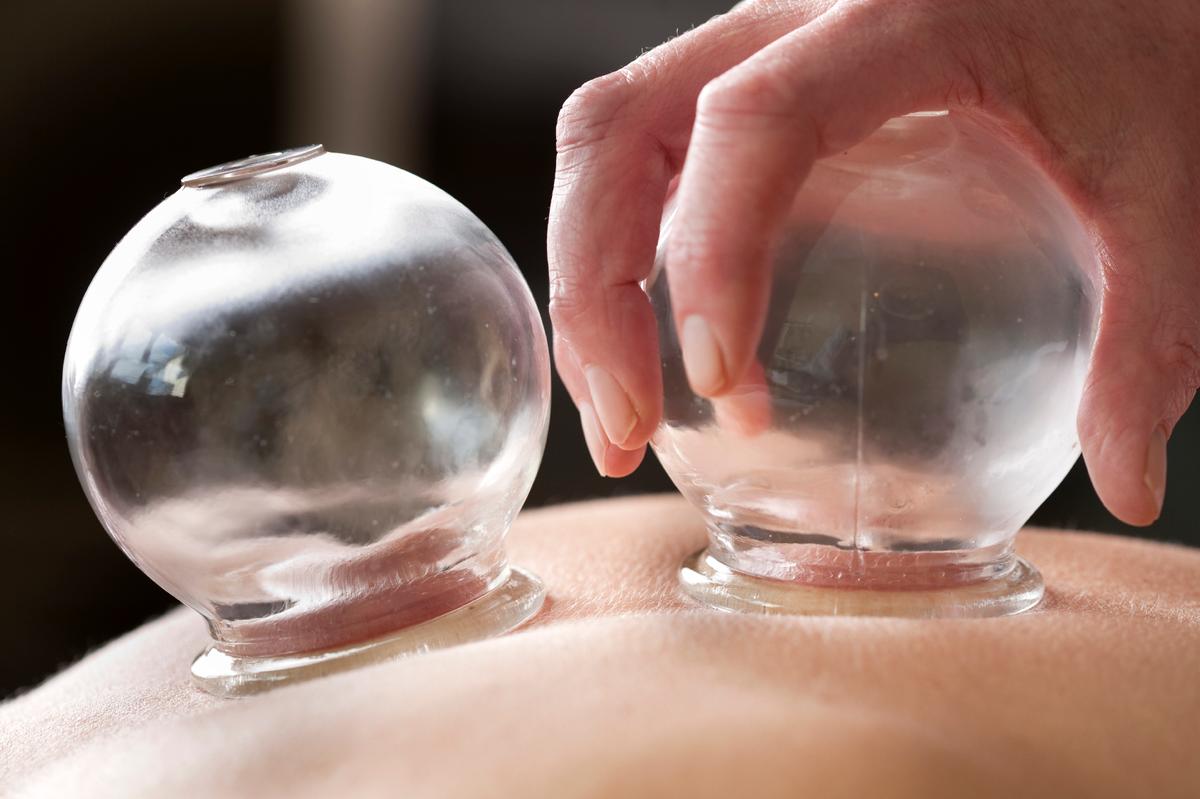 3 Reasons Why You Should Try Cupping