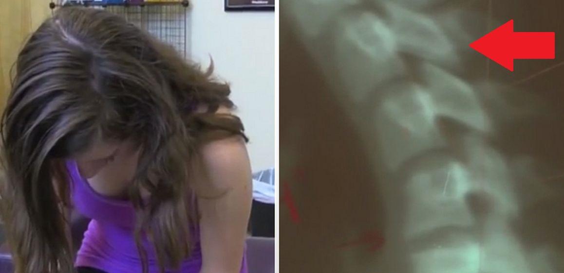 Teen Girl Gets Diagnosed with ‘Text Neck’