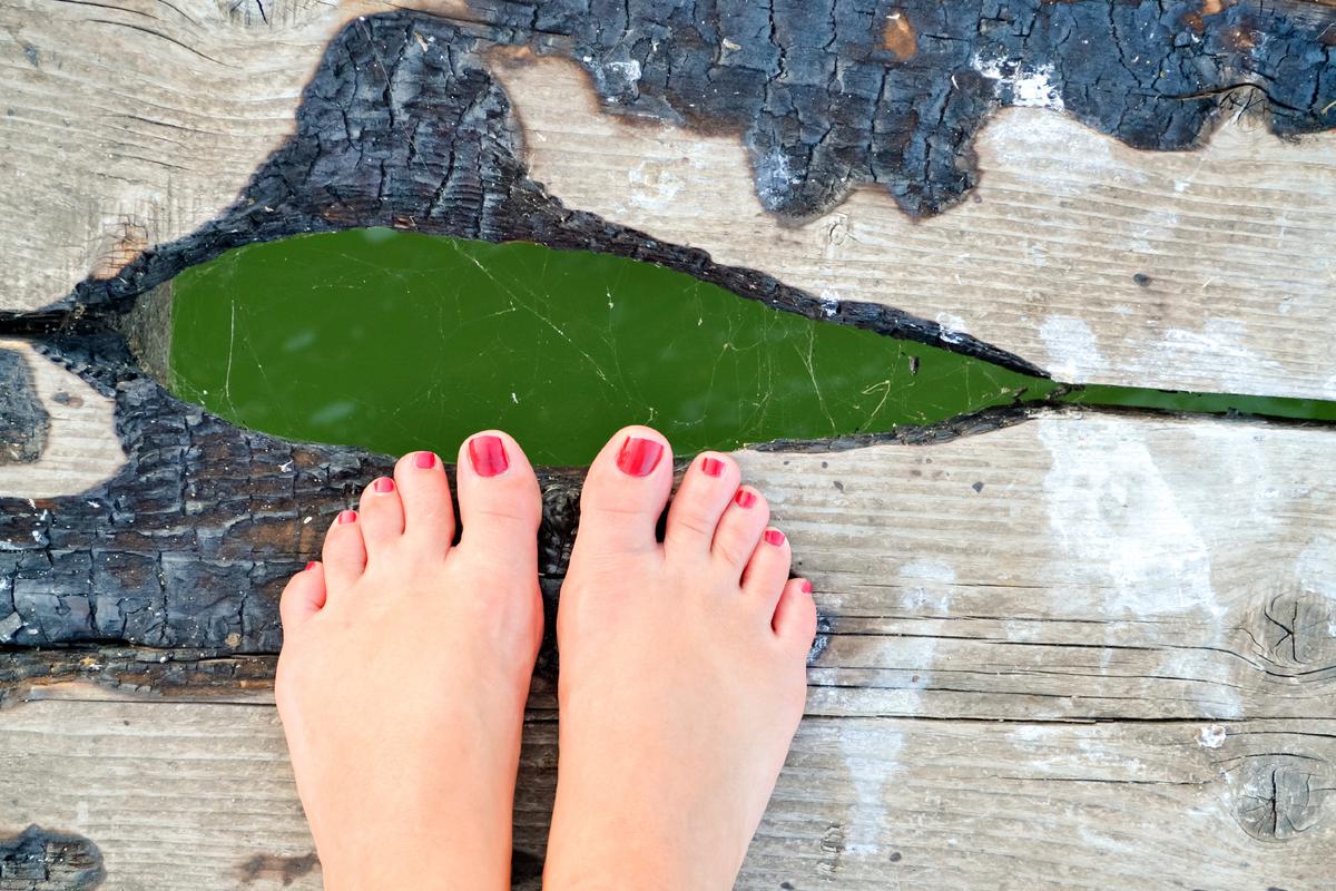 Minimally Invasive Bunion Surgery: No Broken Bones, Quick Recovery