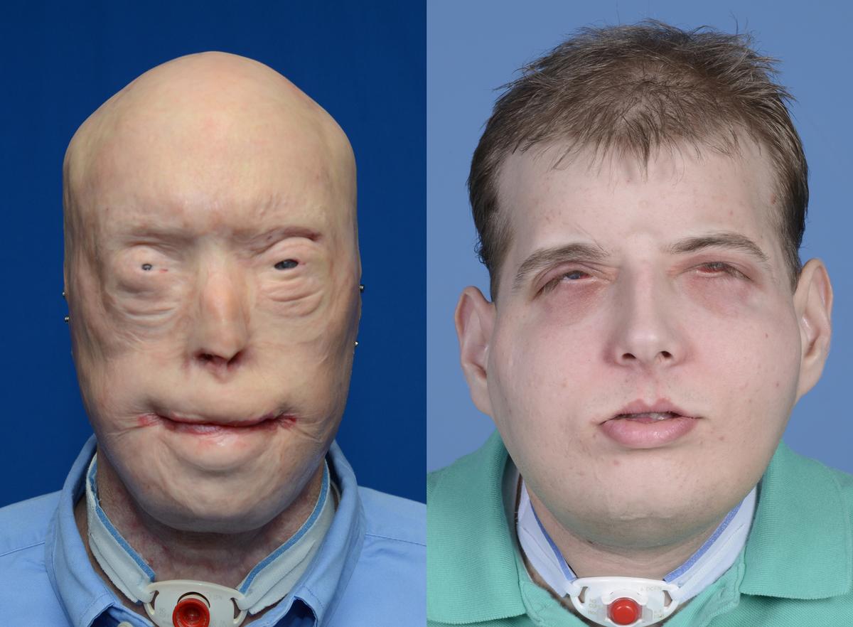 Transplant Gives New Face, Scalp to Burned Firefighter