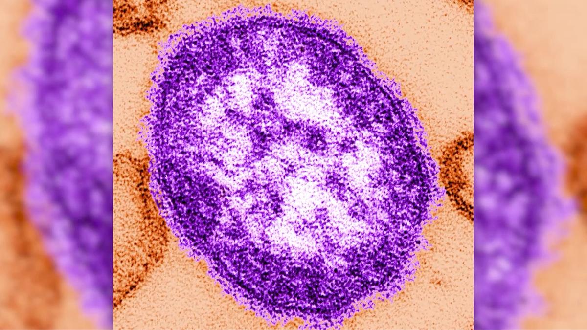 Measles Cases Reported in Illinois, Wisconsin