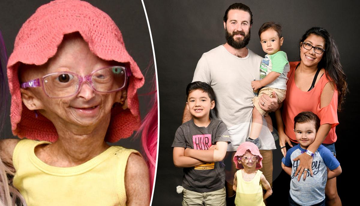 12-Year-Old Girl With Rare ‘Aging Disease’ Becomes Internet Sensation Despite Negativity