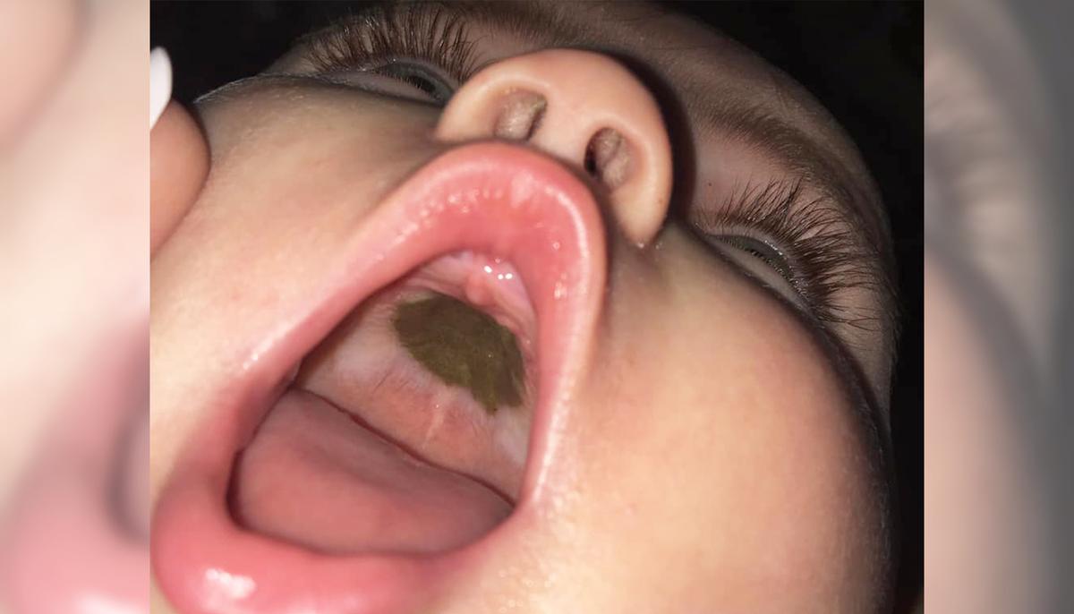 Mom Mortified When Nurse Reveals What the Black Mark in Baby’s Mouth Is