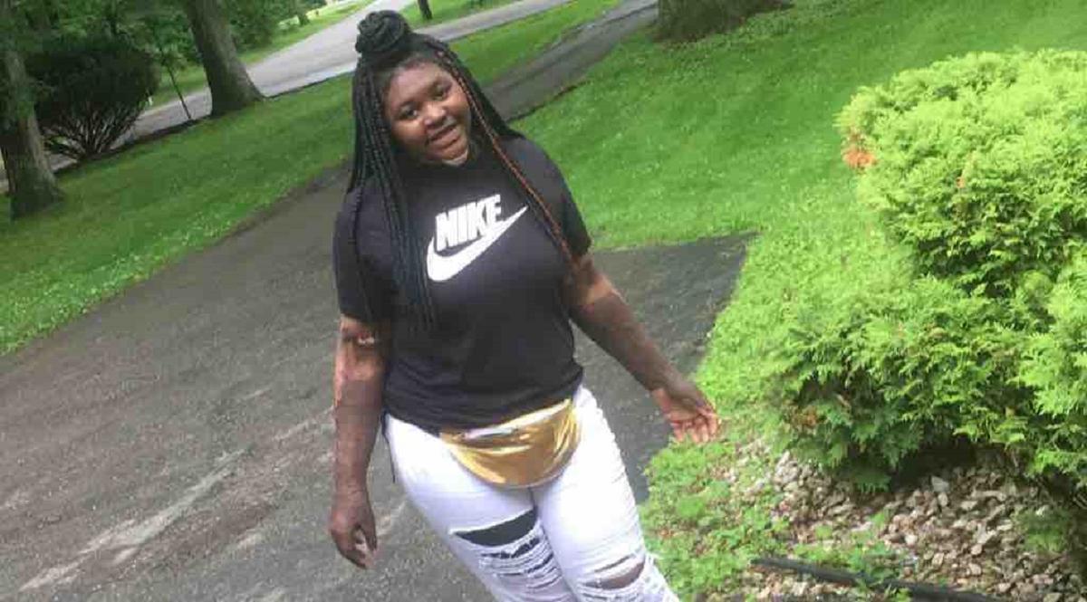 Girl Who Burned 49 Percent of Her Body During ‘Fire Challenge’ Issues Warning, Thanks God