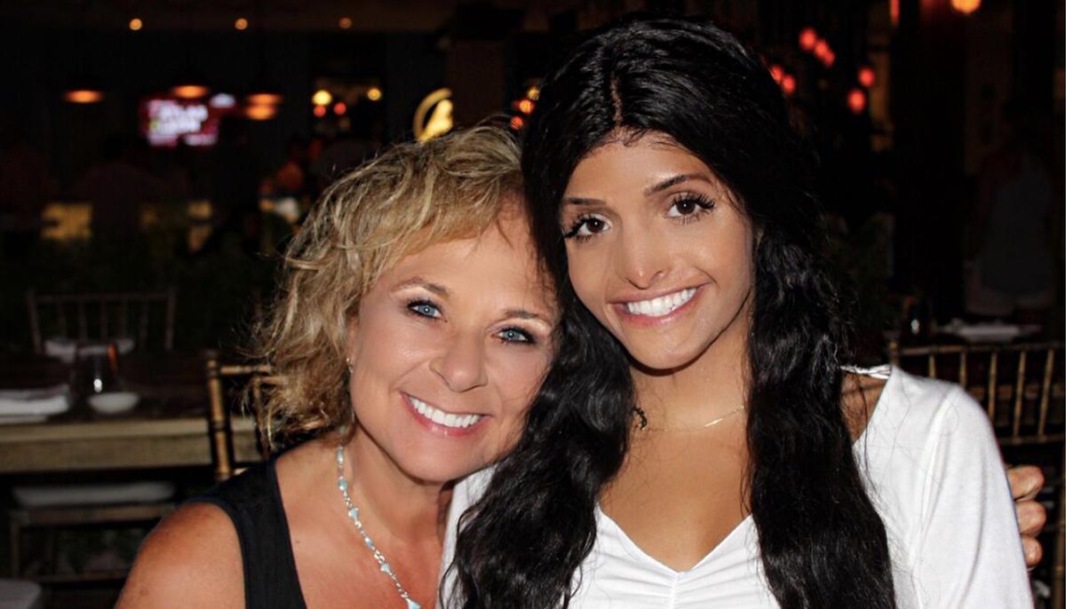 Girl Disfigured by a Bomb Explosion in Iraq Gets Second Chance From a Stranger in US