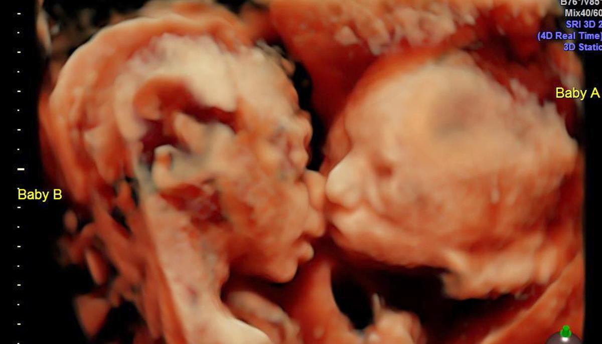 24-Week Sonogram Reveals Unborn Twins ‘Kissing’ in the Womb–and the Photos Go Viral