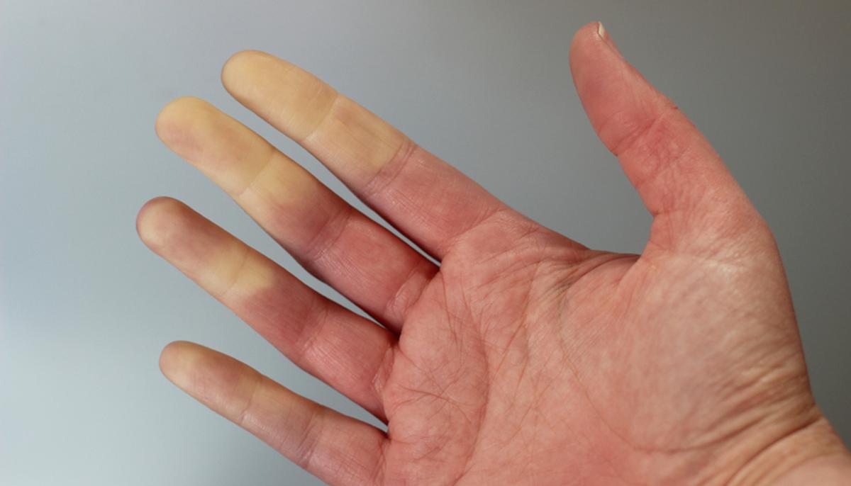 Hands and Feet Going Numb and Changing Color? It Might Be This Disorder: