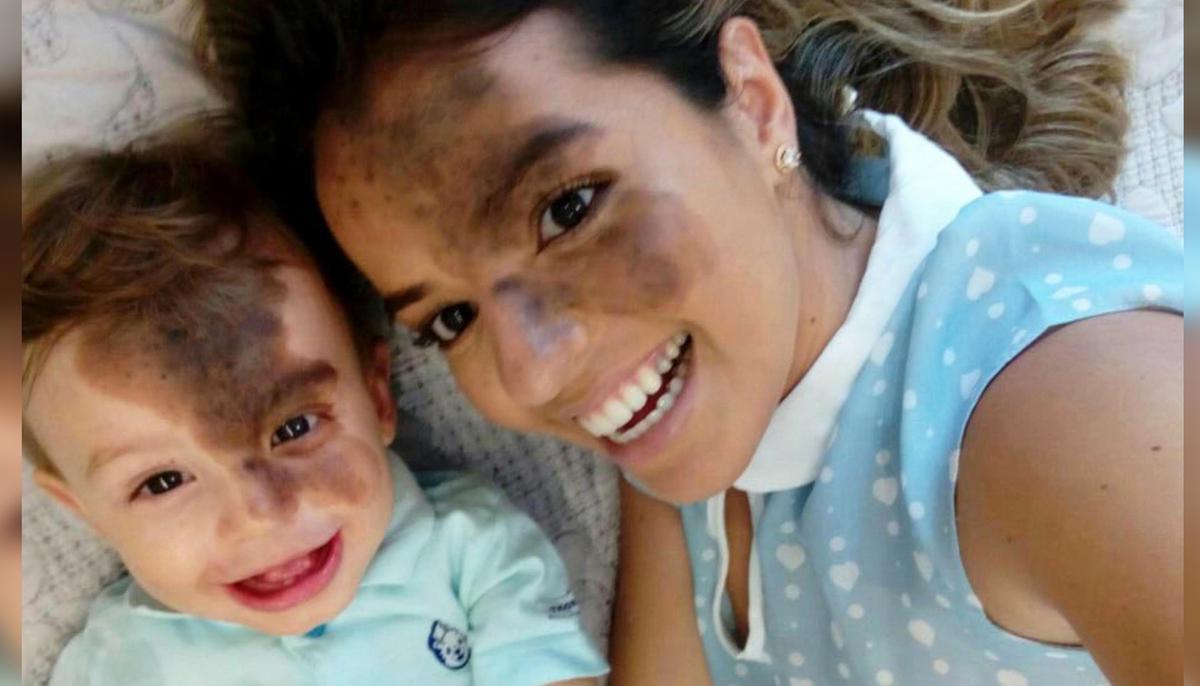 Mom Paints Her Face to Help Son With ‘Kiss of God’ Facial Birthmark Build Self-Confidence