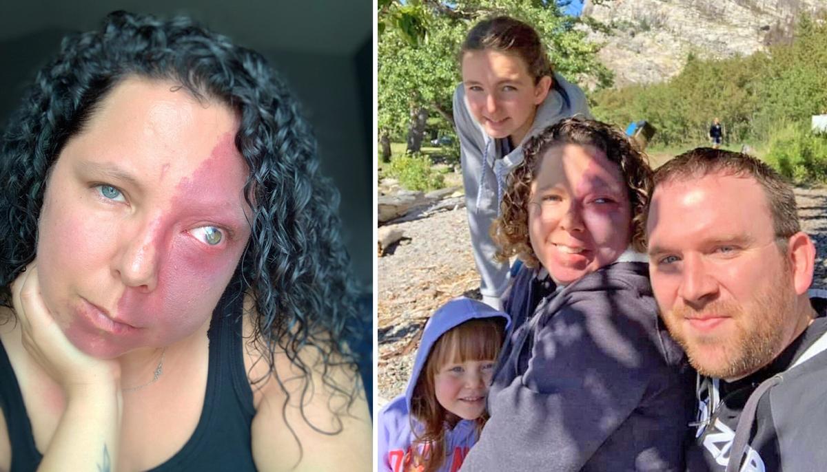 Mom Who Was Bullied for Facial Birthmark Thought She'd Never Find Love, Now Has a Dream Family