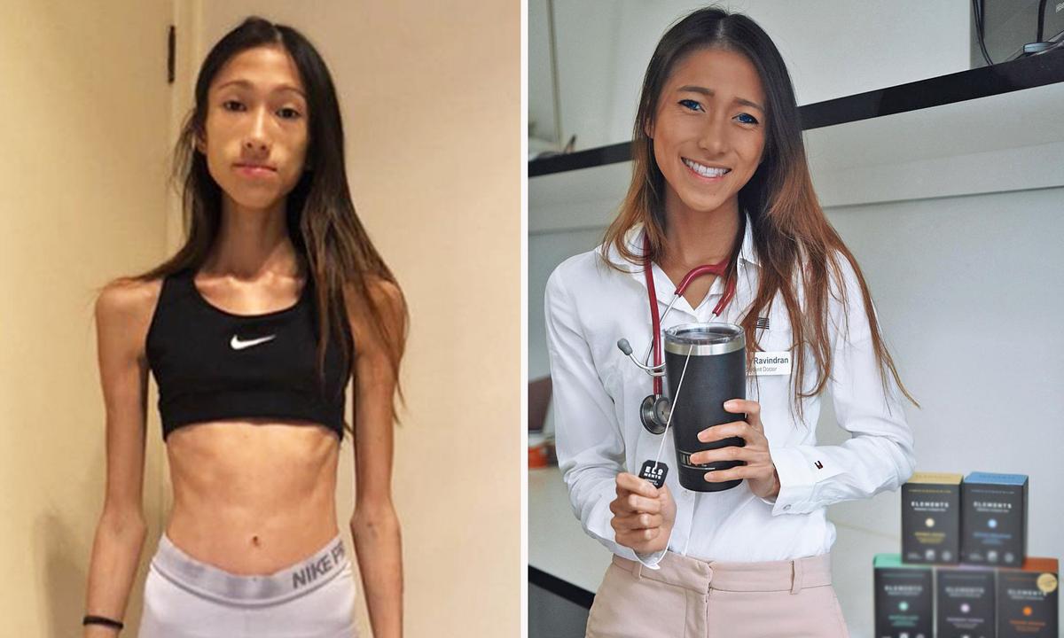 66lb Woman Recovers From Eating Disorder, Trains as Doctor in Hopes of Saving Others
