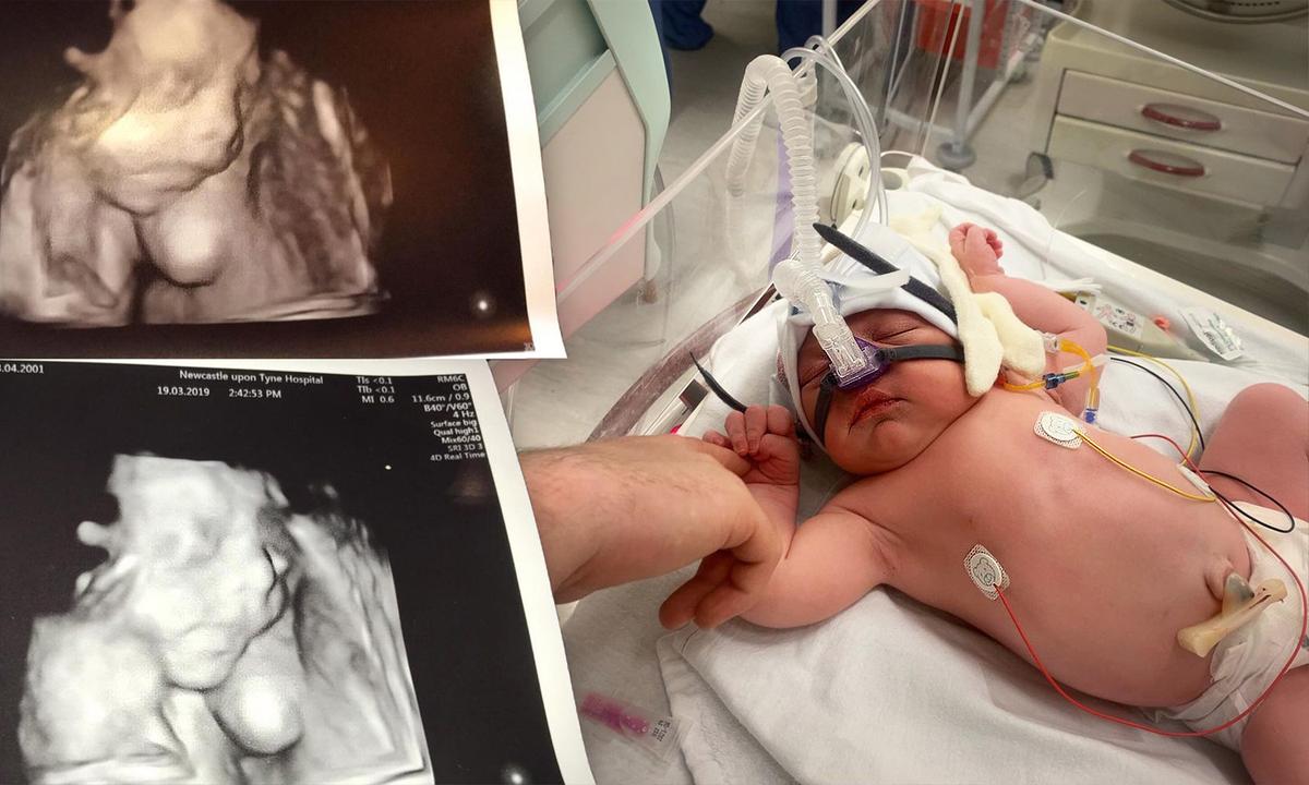 22-Month-Old’s Lungs Collapsed After He Was Born With Cysts—but Thanks to Health Workers, He’s Thriving