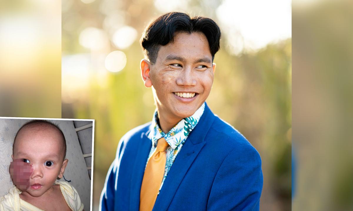 Vietnamese Baby With Facial Tumor Gets Adopted in the US, Reunites With Birth Parents at 18
