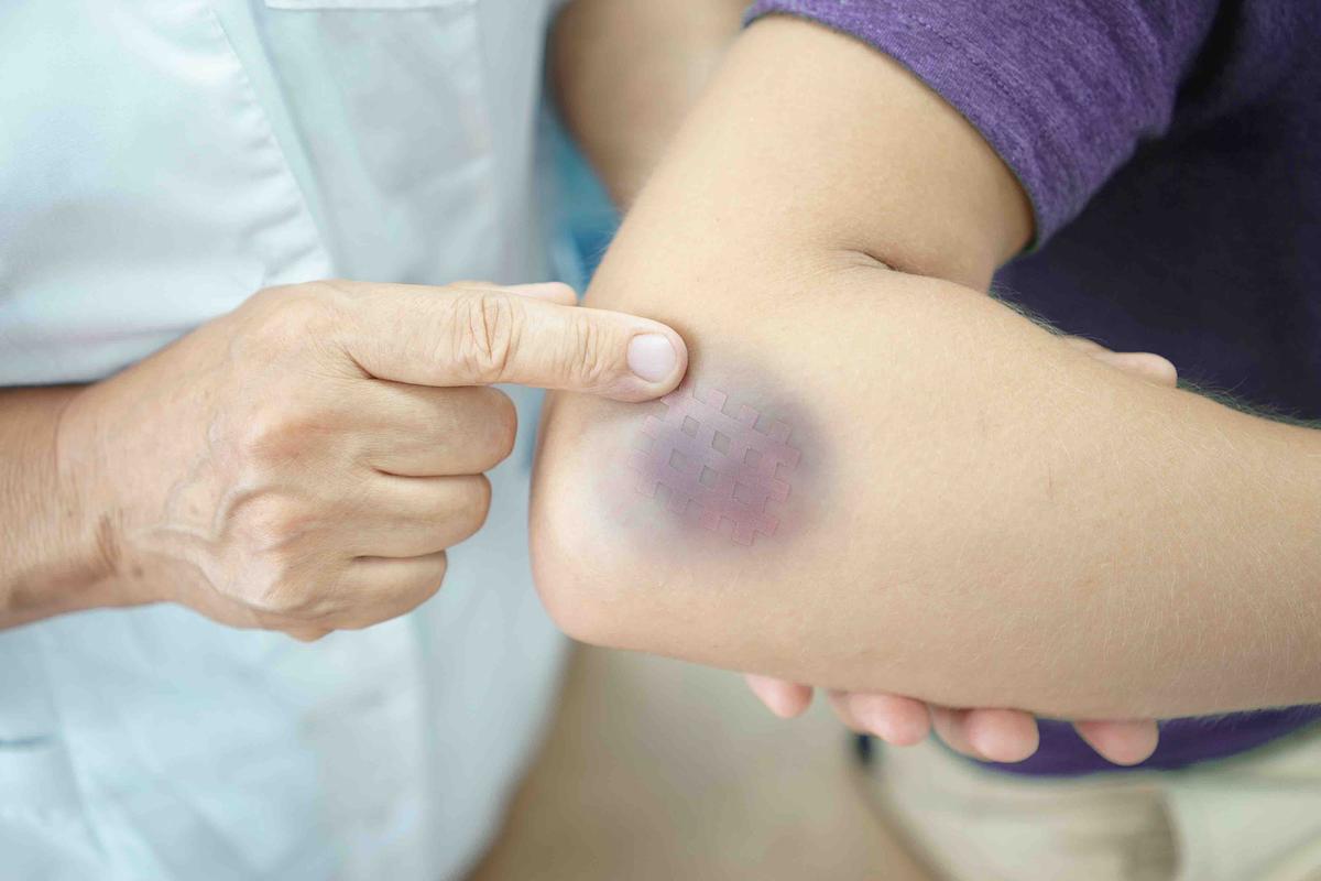 Bruising Questions