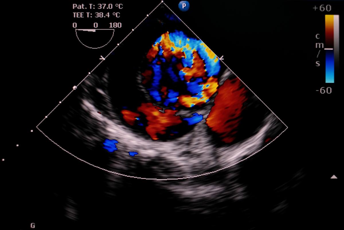 Aortic Dissection After COVID-19 Vaccination
