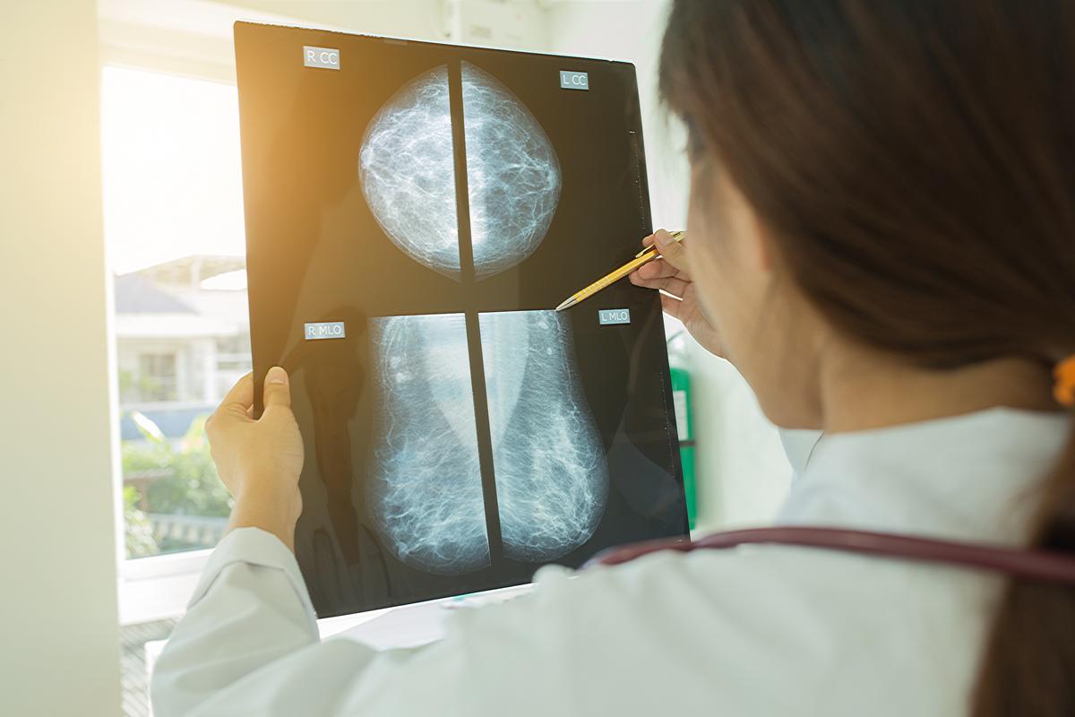Yes, Breast Cancer Can (And Often Does) Spontaneously Regress