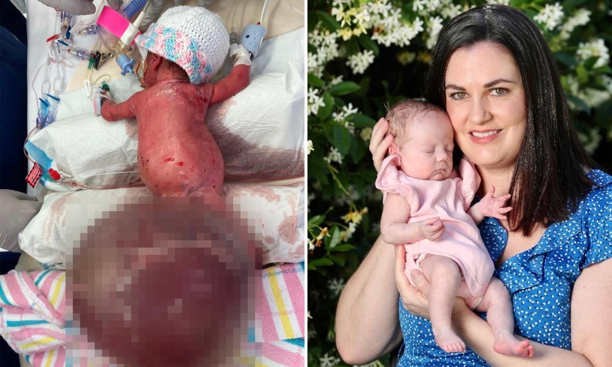 ‘Little Fighter’ Preemie Baby Thrives After Surgeons Remove Spinal Tumor That Was Twice Her Weight