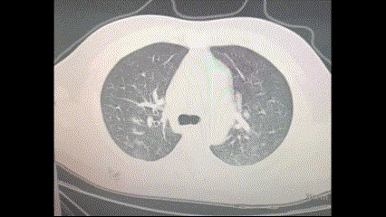 Computed Tomography scan of the ground source's lungs after developing flu-like symptoms in mid-December 2022. (The Epoch Times)