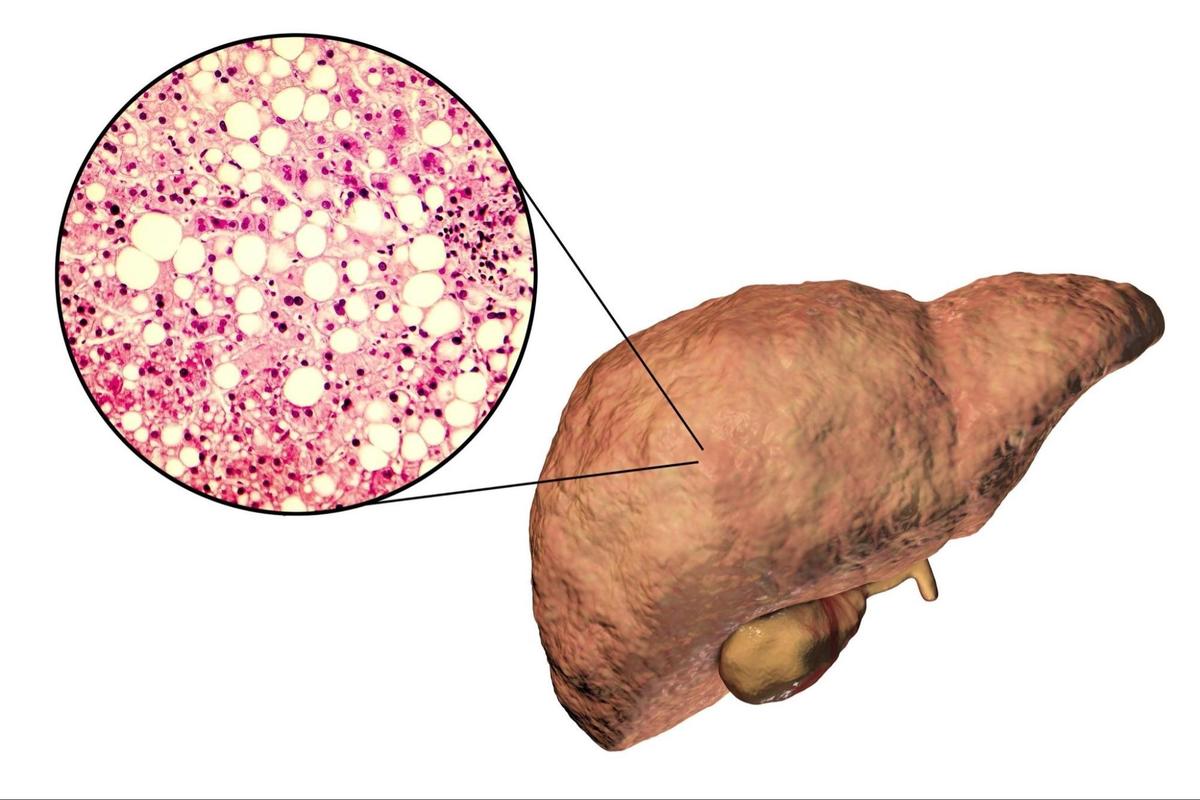 Fatty Liver Increases Risk of Liver Cancer–Tips for Early Detection and Prevention
