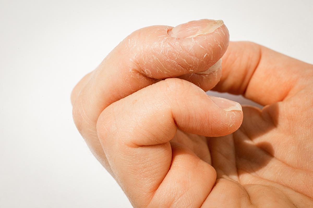 Common Nail Conditions May Indicate You’ve Had COVID