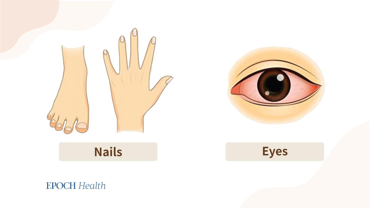 Traditional Chinese medicine can assess liver function by observing the appearance of the nails and eyes. (The Epoch Times)