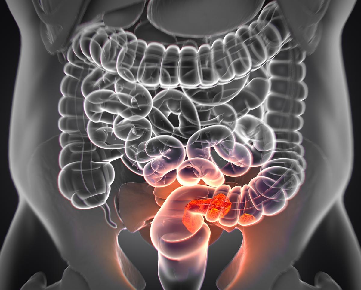 8 Major Risk Factors for Colorectal Cancer and 3 Tips for Nurturing Digestive Health