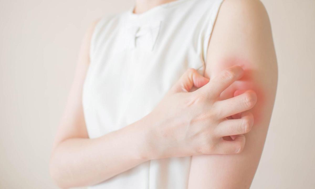 Long COVID Causes Skin Allergies and Itching, Tips for Alleviating Symptoms