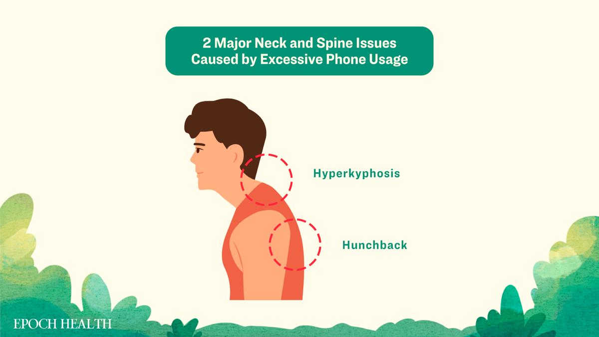 Common neck issues associated with excessive mobile phone usage: hyperkyphosis and hunchback. (The Epoch Times)