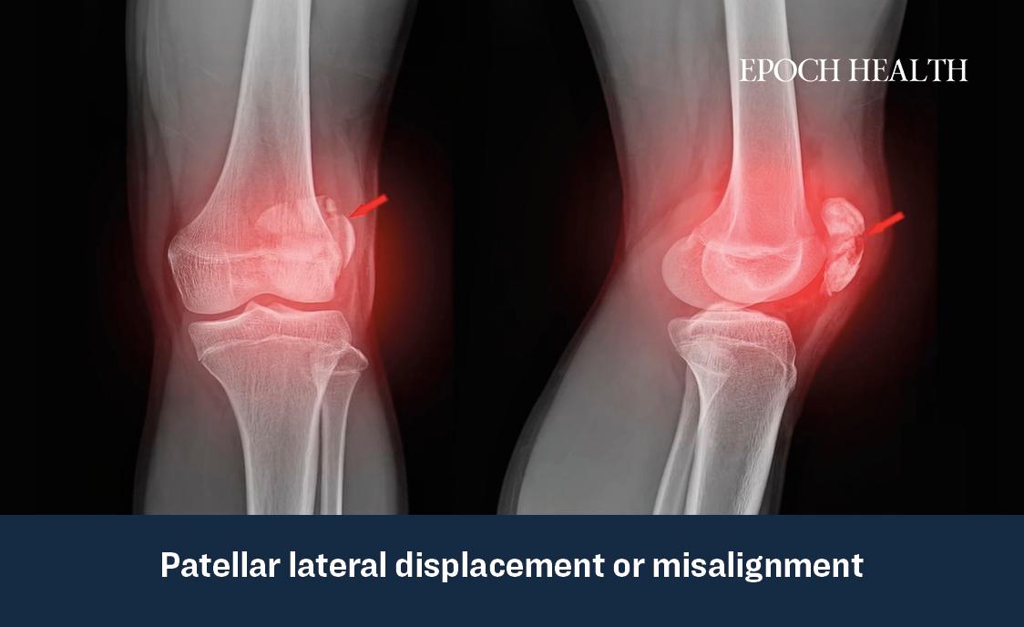 Crossing your legs frequently can lead to patellar misalignment or displacement. (The Epoch Times)