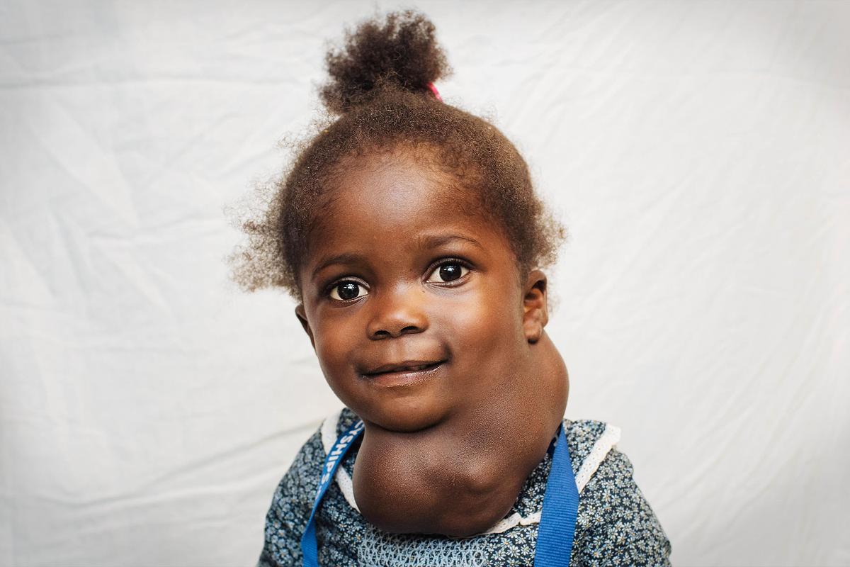 Toddler Was Born With Face-Sized Mass Growing on Her Neck Suffocating Her—Until Surgeon Saves Her