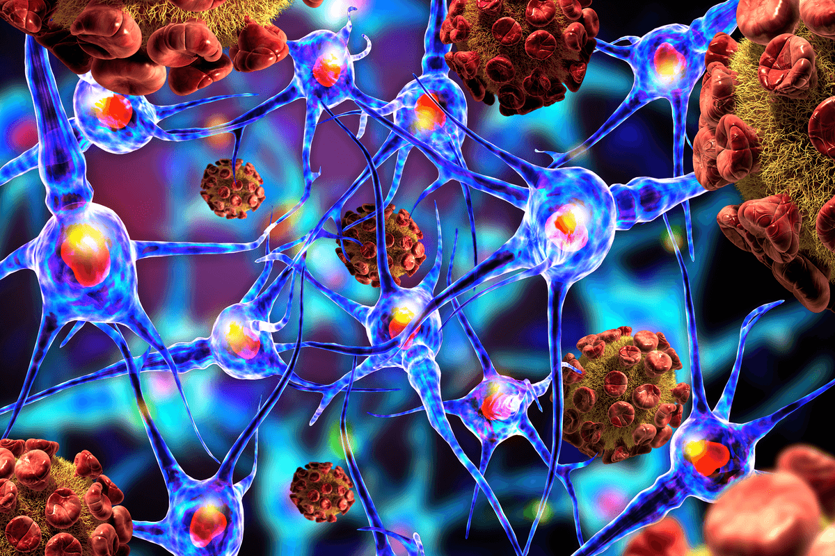 Rare Neurological Disorder Linked to COVID-19 Vaccination, Research Suggests