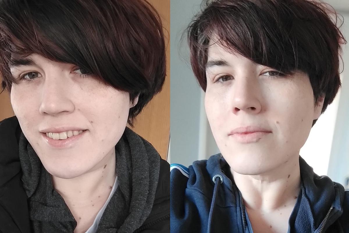 ‘Detransitioner’ Who Was Undiagnosed Autistic Calls for Reform of Adult Gender Services