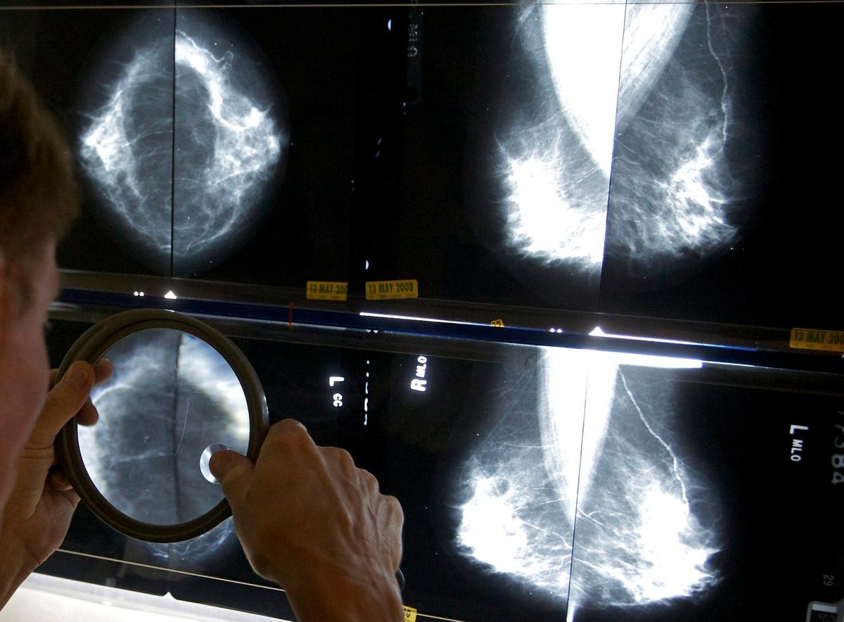 Canadian Cancer Cases and Deaths Expected to Increase in 2024: Study