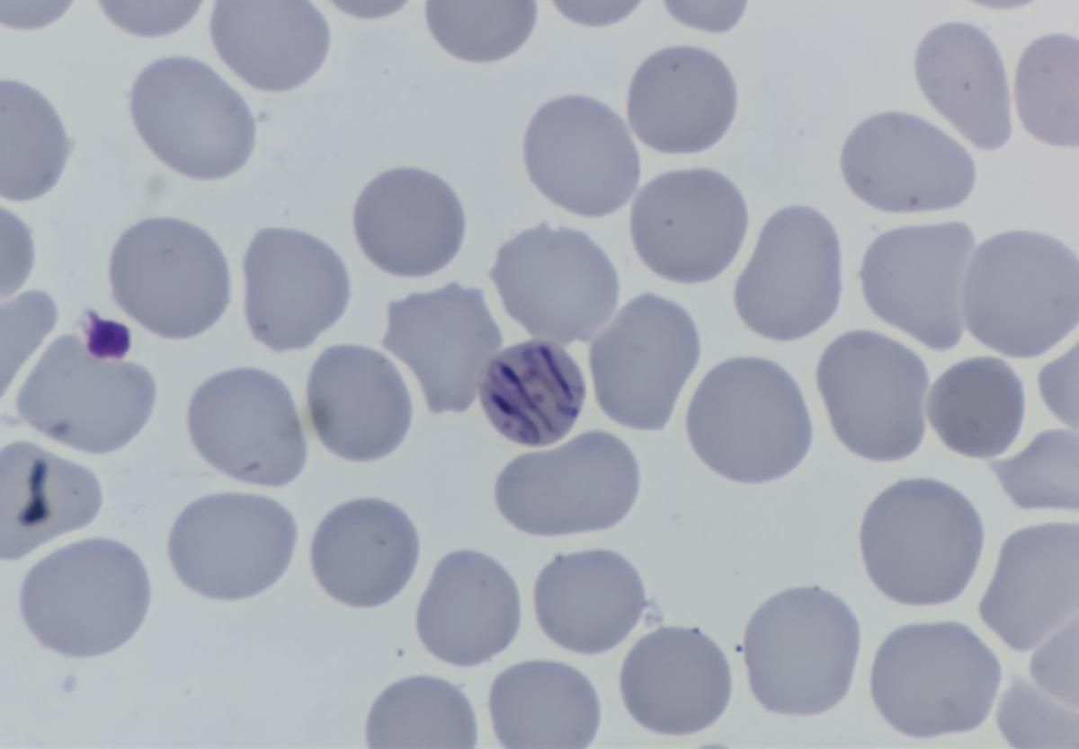 Southeastern Ontario Health Unit Probes 114 Cases of Parasitic Stomach Illness
