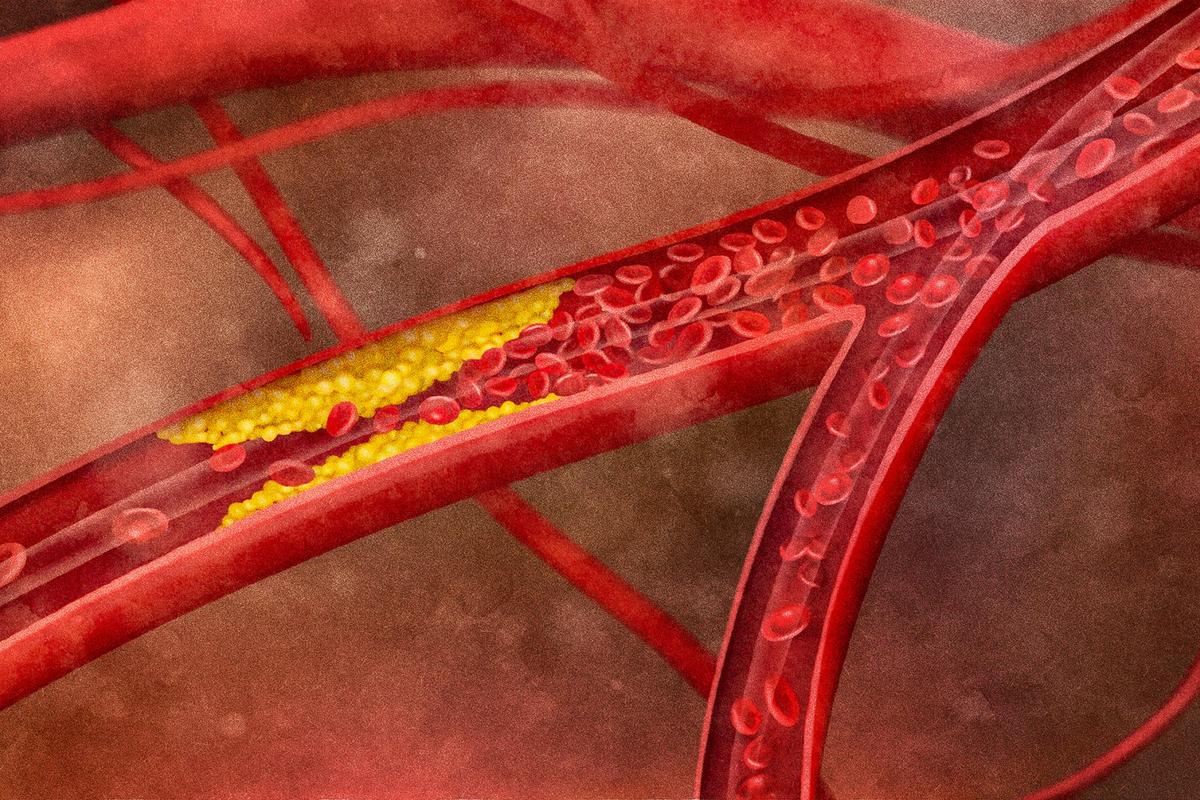 Cholesterol-Lowering Drugs May Affect Your Health