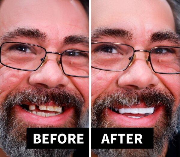 (Source: Shiny Smile Veneers)