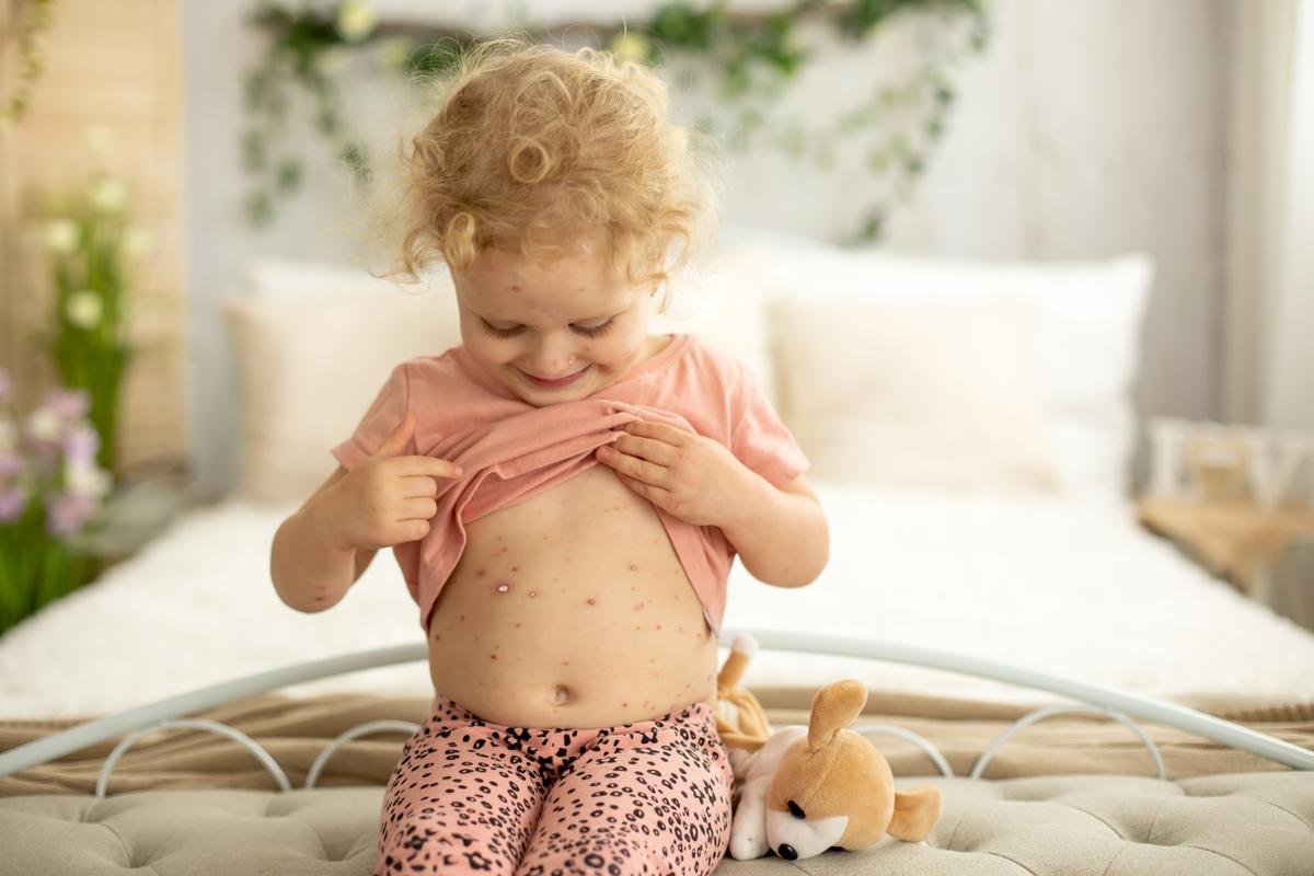 The Chicken Pox Controversy