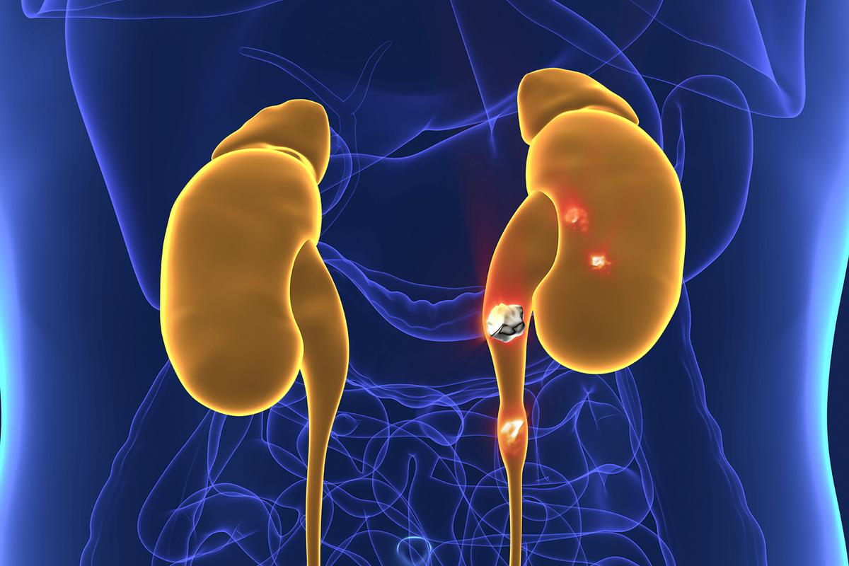 Bacteria May Help Common Kidney Stones Grow: Study